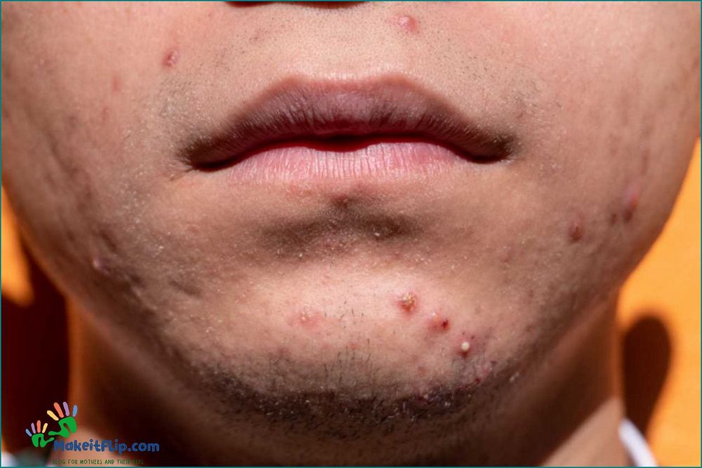 Lip Acne Causes Treatment and Prevention