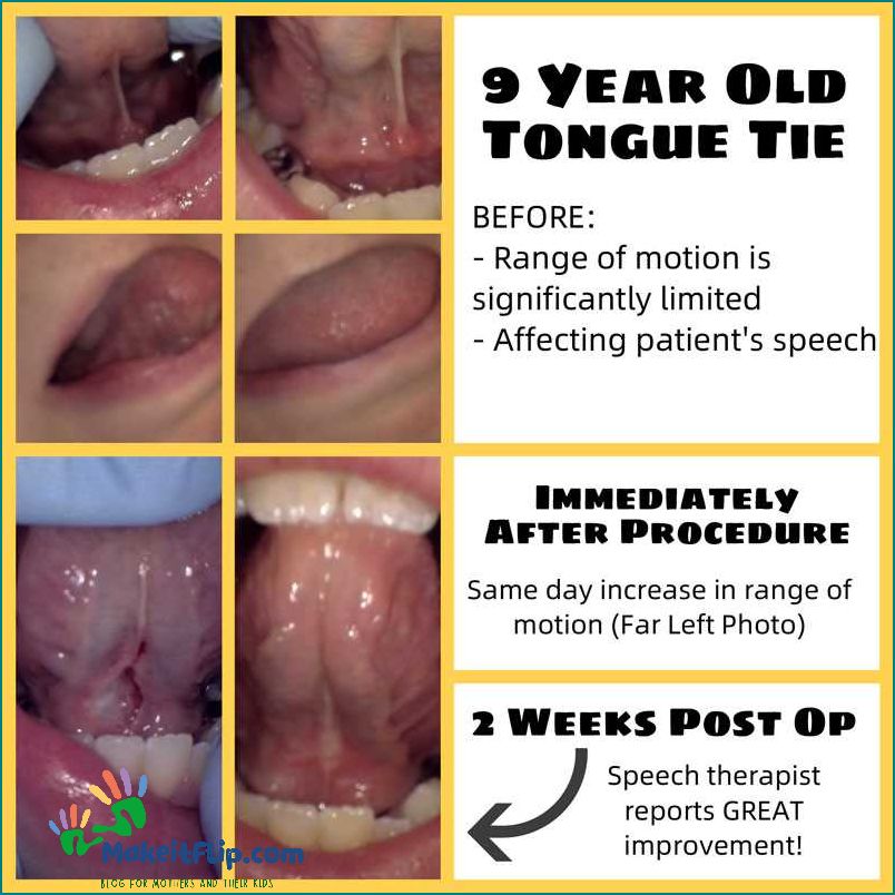 Lip and Tongue Tie Causes Symptoms and Treatment Options