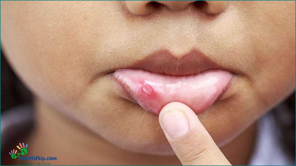 Lip Burn Causes Symptoms and Treatment