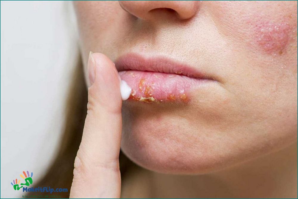 Lip Burn Causes Symptoms and Treatment