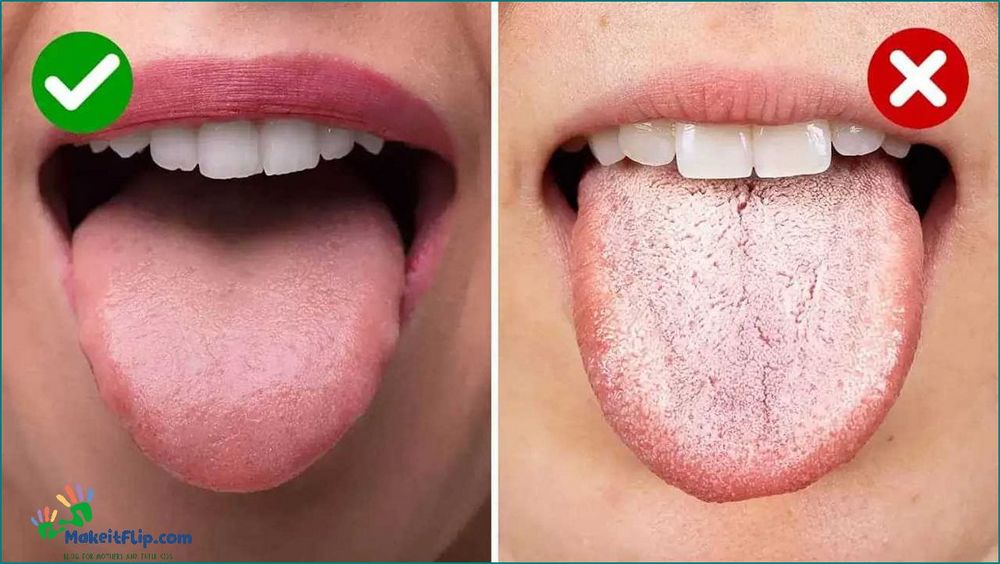 Baby White Tongue Causes Symptoms and Treatment