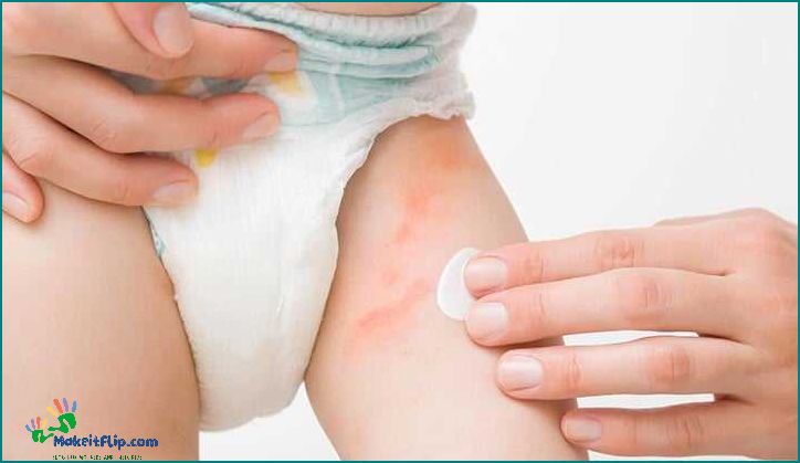 Clotrimazole for Diaper Rash How to Treat and Prevent Diaper Rash