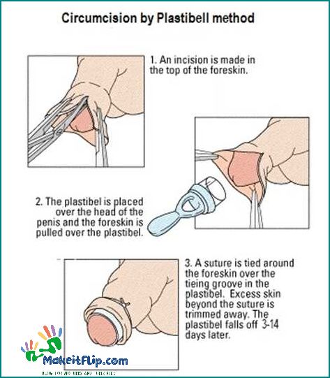 Plastibell Circumcision Procedure Benefits and Risks