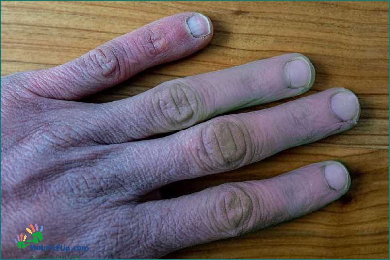 Purple Finger Causes Symptoms and Treatment
