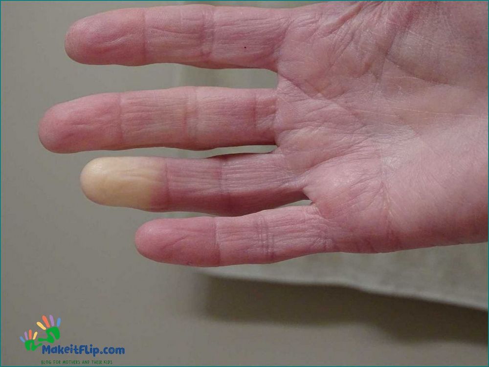 Purple Finger Causes Symptoms and Treatment