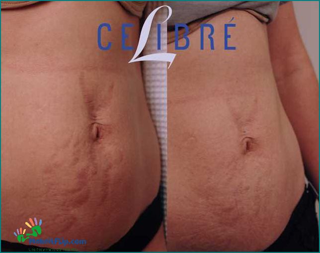 Stretch Mark Removal Surgery Get Rid of Stretch Marks Permanently