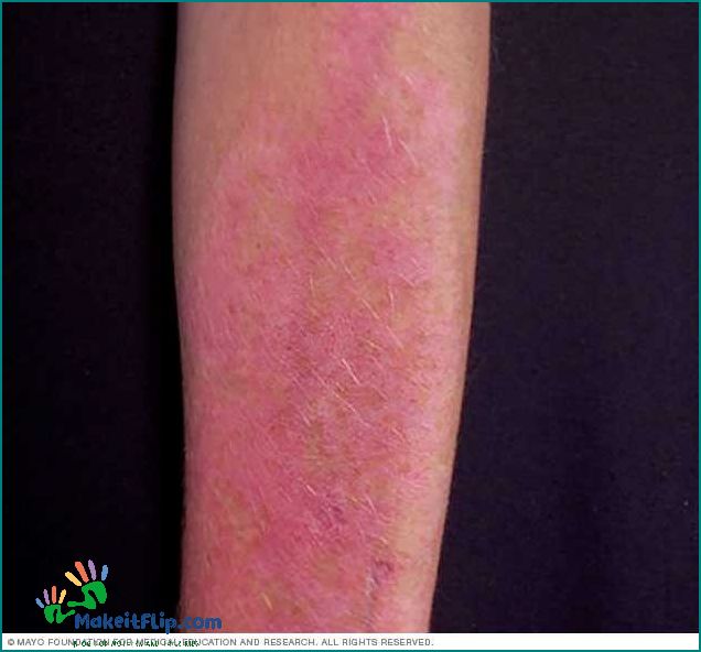 Sun Rash Pictures Symptoms Causes and Treatment Options