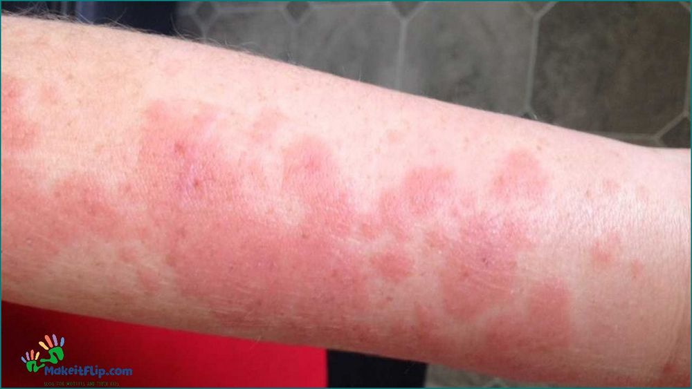 Sun Rash Pictures Symptoms Causes and Treatment Options