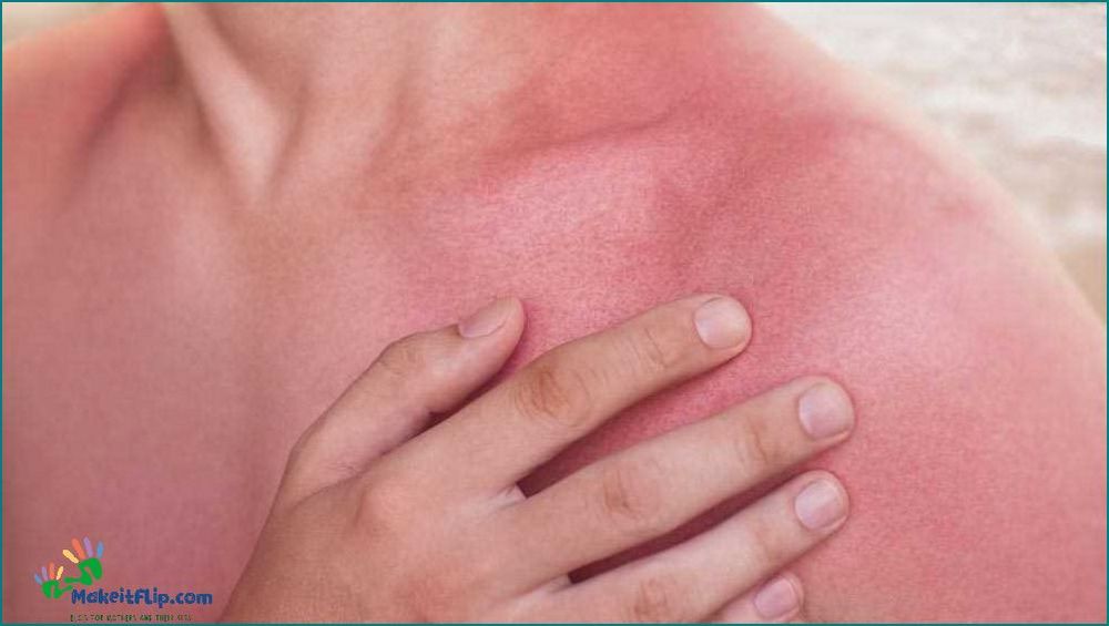 Sunburn Itch Causes Symptoms and Effective Remedies