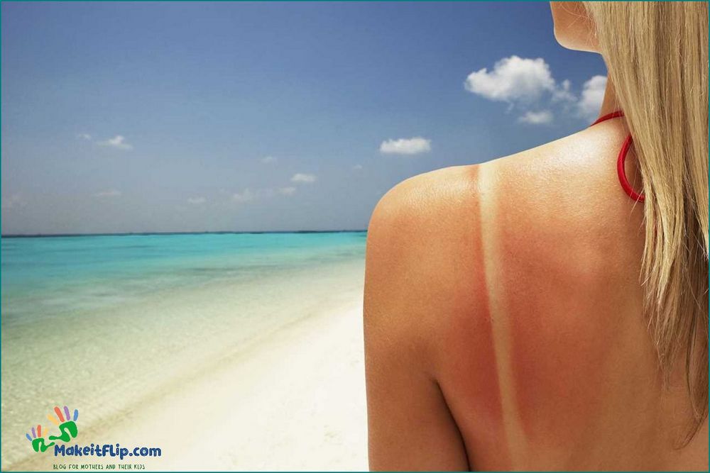 Sunburn Itch Causes Symptoms and Effective Remedies