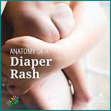 How to Treat Teething Diaper Rash Tips and Remedies
