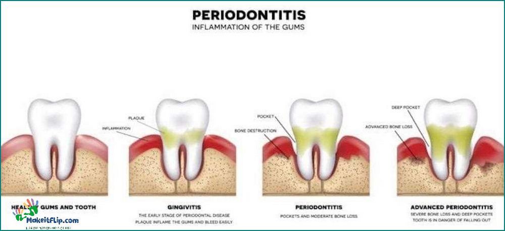Tooth Abscess Stages Understanding the Progression of Dental Infections