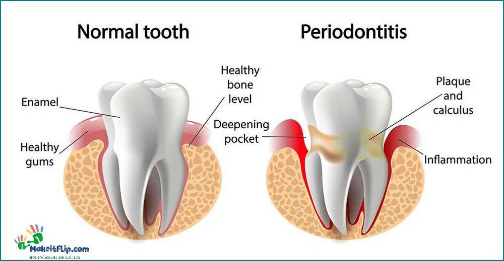 Tooth Abscess Stages Understanding the Progression of Dental Infections