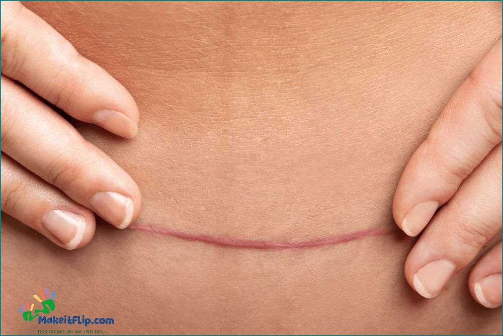 Tubal Ligation Scar What You Need to Know