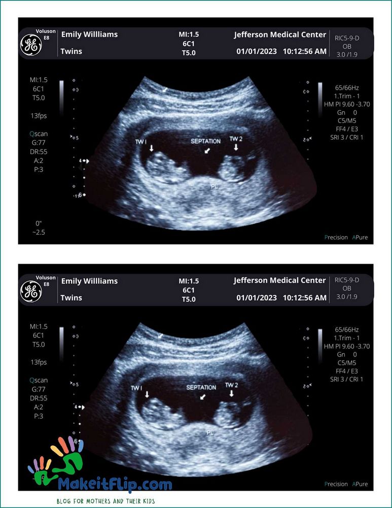 Twin Ultrasound Everything You Need to Know