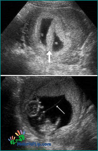Twin Ultrasound Everything You Need to Know