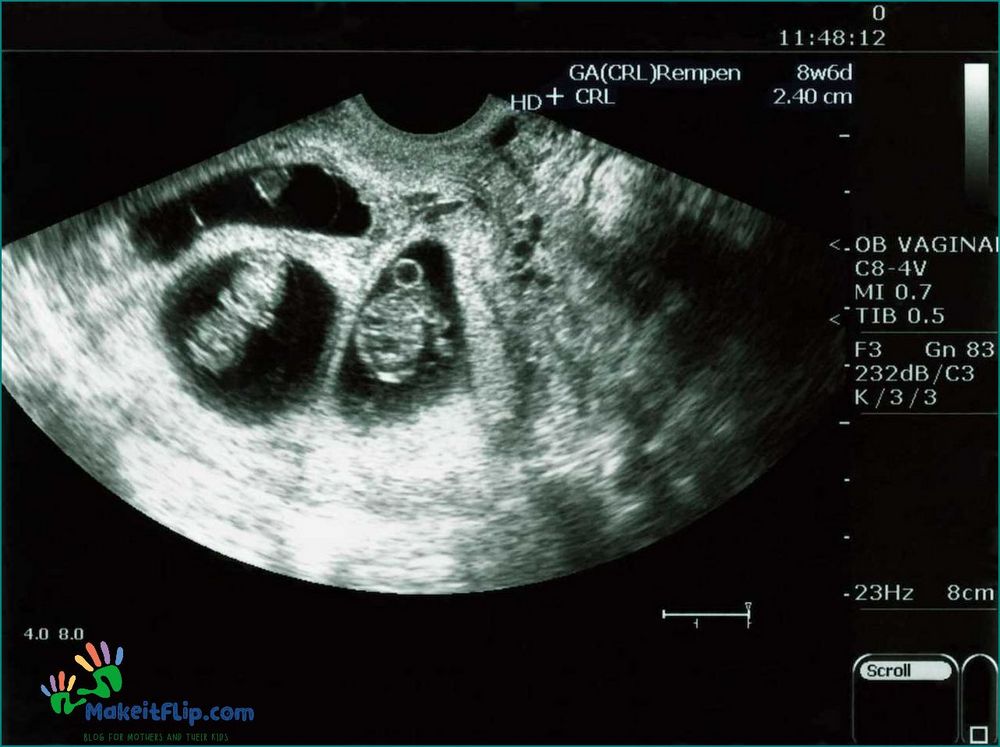 Ultrasound Pictures of Twins Capturing the Miracles of Multiple Blessings