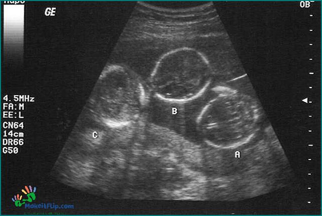 Ultrasound Triplets Everything You Need to Know