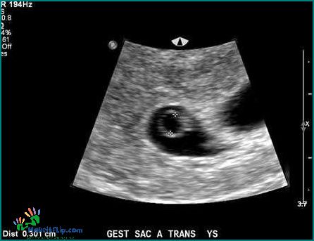 Ultrasound Triplets Everything You Need to Know