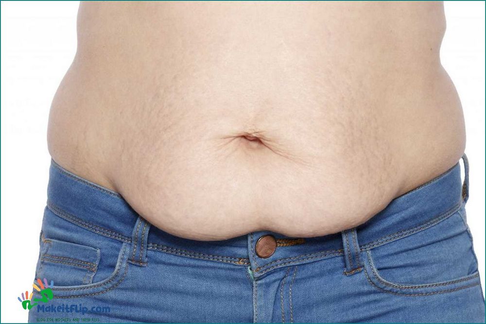 Understanding Abdominal Separation Causes Symptoms and Treatment