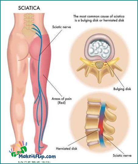 Understanding and Managing Back Pain after Epidural Causes Symptoms and Treatment Options