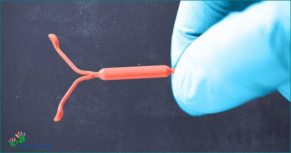 Understanding the Role of IUDs in Managing Endometriosis