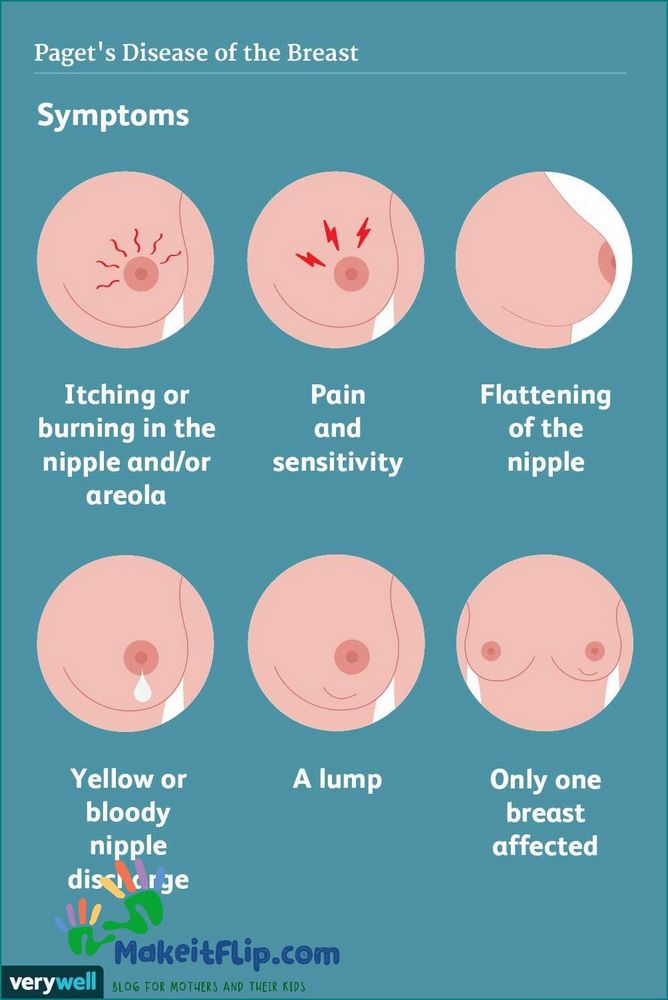 Understanding White Nipples Causes Symptoms and Treatment Options