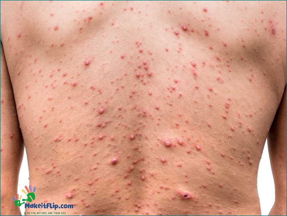 Why is chicken pox called chicken pox Unraveling the Name's Origins