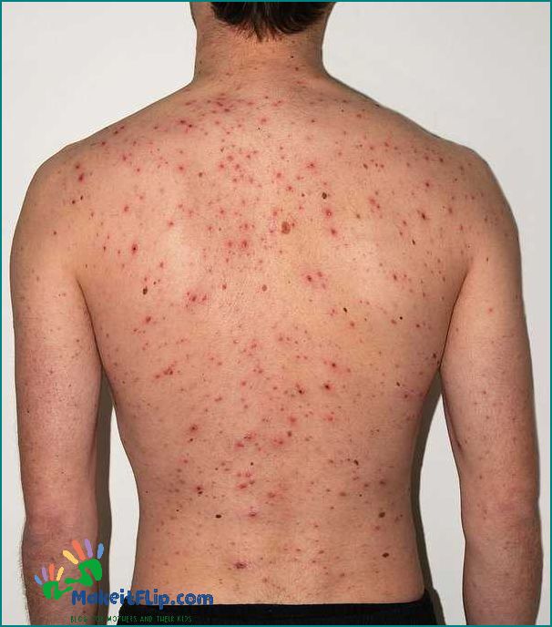 Why is chicken pox called chicken pox Unraveling the Name's Origins